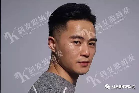 微针植发3631变身霸道男神9个月记录