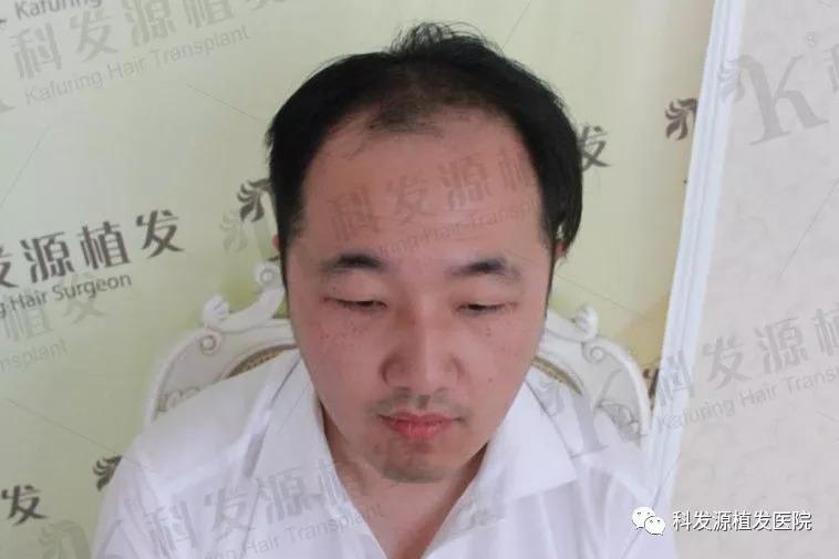 四级雄脱南京微针植发让主持人不再显老
