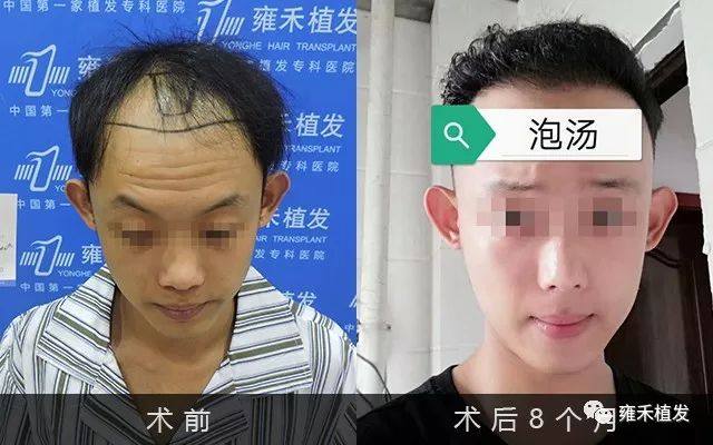 植发2656单位8个月这么浓密这么帅