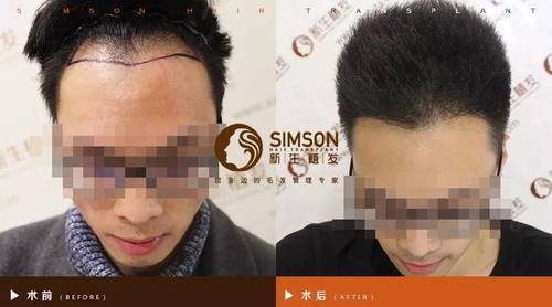 发际线植发2000单位7个月时间植发效果