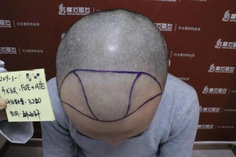 朋友介绍来到摩范植发解决了多年的烦恼变成阳光大男孩