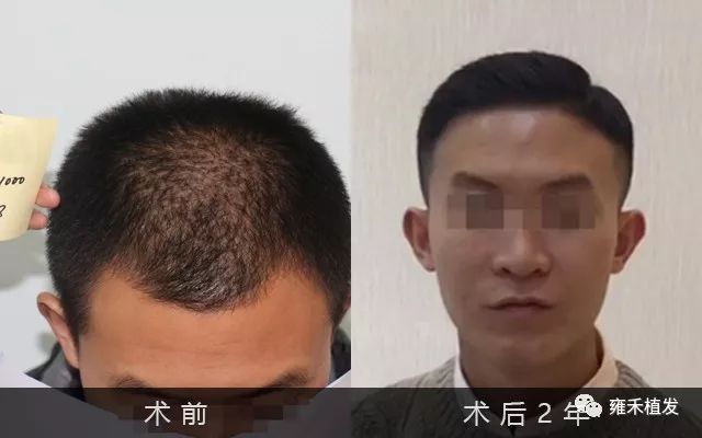 他植发1年后找上门植发医院不认他了怕担责任？