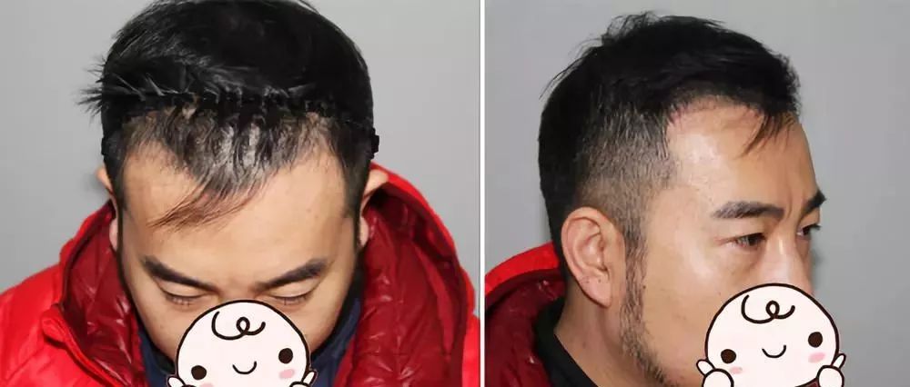 北京中德植发徐霞做发际线种植一年内的真实变化