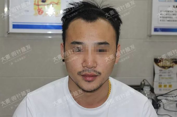 帅小伙儿植发3690单位拥有迷人发际线和鬓角！