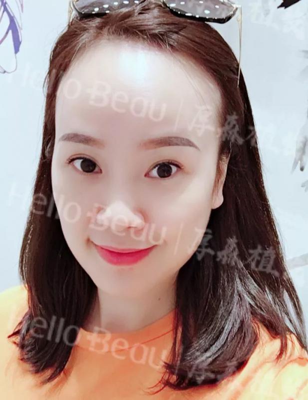 犹豫多年32岁的我终于摆脱了大脑门