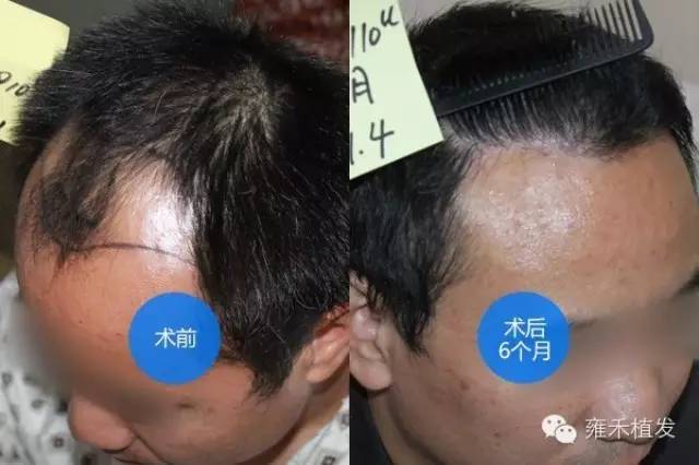 脱发呈A型缺口植发成A级形象3178单位6月效果