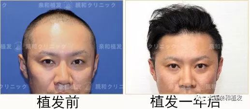 大连植发2000单位我觉得自己年轻了十岁