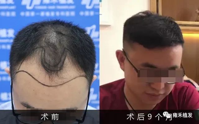 90后脱发头顶稀疏植发2个90天后是少年归来！