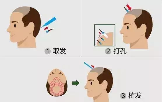 M型发际线植发调整2200单位术后效果！