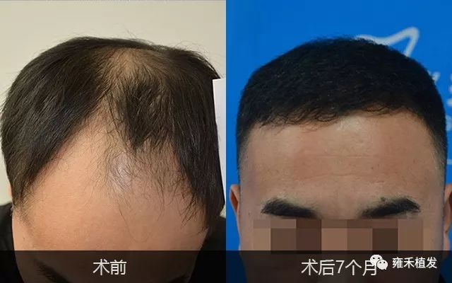 美发店老板6级脱发植发4145单位后7个月