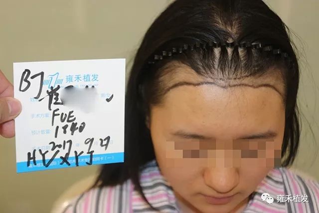 她是19岁女生跨夜植发2192单位
