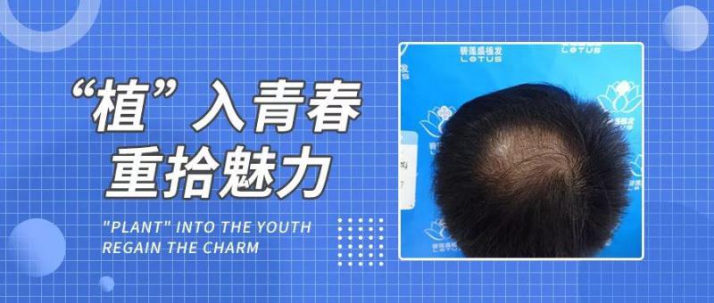 头顶一片荒芜加密植发3200单位5个月后竟成这样！