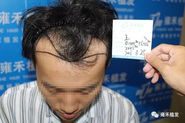 不理发植发！当天就藏住植发痕迹！2445单位半年效果