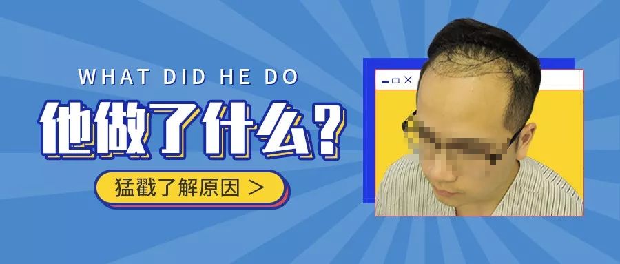 4级脱发种植2500单位植发术后这样做4个月逆袭！