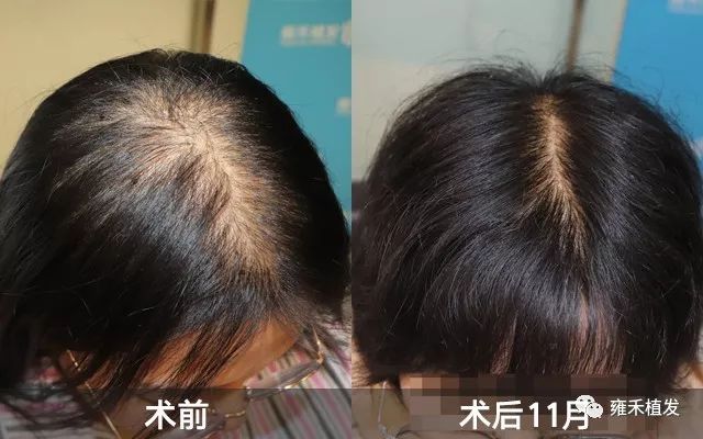 女生熬夜脱发半夜植发2388单位11个月后效果