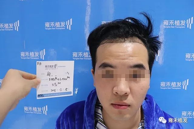 要抢在脱发前相亲却扑空植发3198变帅哥移民出了国
