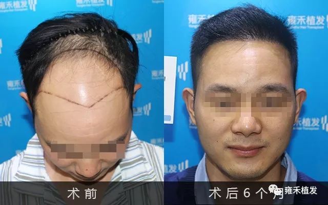 脱发严重影响形象植发又怕被骗吴先生处于纠结状态