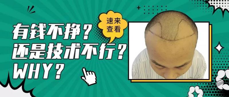 科普3级脱发头顶稀疏到底该能不能加密？