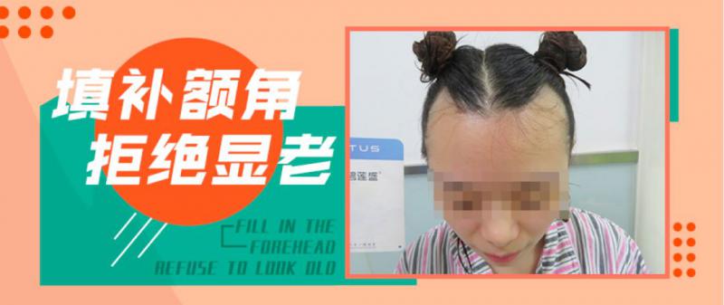 案例女性发际线两额角凹陷到底应该怎么办？