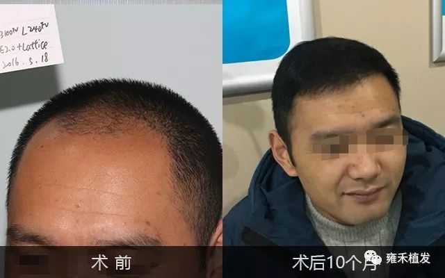 兵哥哥是秃哥哥植发3450单位变帅哥哥！
