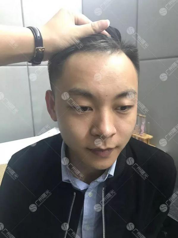 24岁IT男相亲失败女生建议他去植发3个月后
