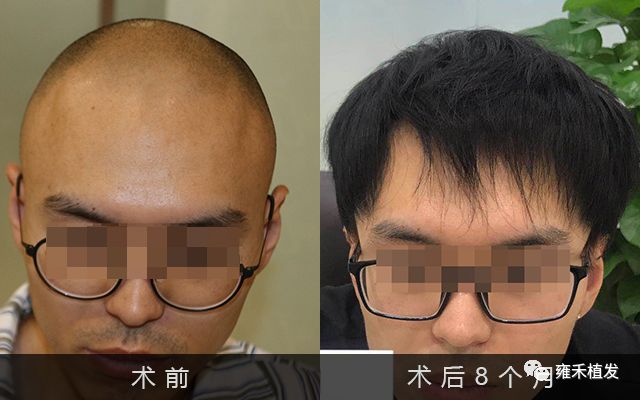 留美学生植发3869单位重新帅起去时秀发归国光头