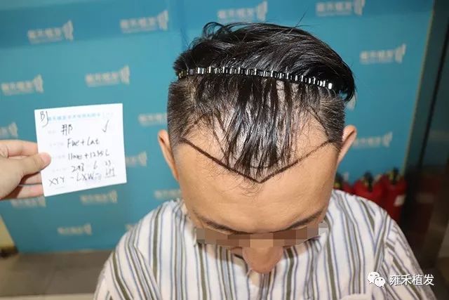 秃头老师影响恋爱赶紧种发际线种眉毛1年后效果