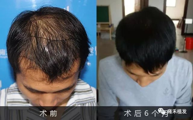 植发4355单位！老板发秃植发半年发福头发的福气