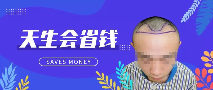 3级脱发只种植2275毛囊单位天生的优势羡慕不来