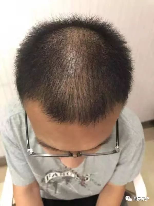 给您讲述一对植发路上父子兵的真实故事
