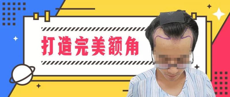 额角植发1900毛囊单位，重获自信！
