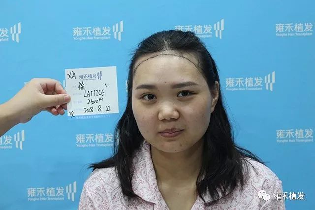 雍禾员工女护士植发她说手术时前两针有点疼然后就不疼了