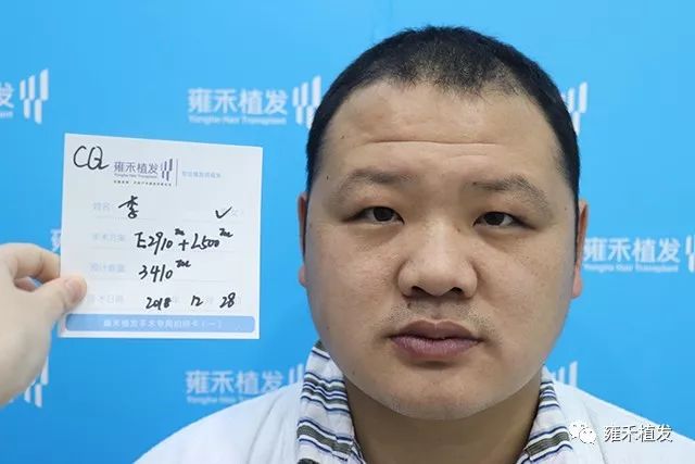头上三处脱发压力山大植发3450单位