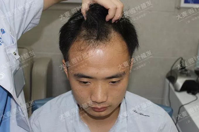 雄脱3年研究生小张植发3018单位变强不秃