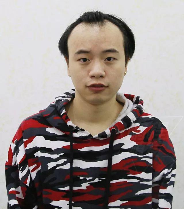 植发案例从额角严重后退到成功改变