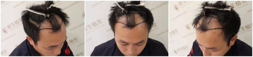 前额头发种植3000单位毛囊年轻十岁不是问题