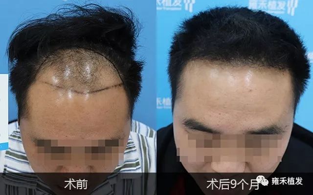 个体户秃到头顶植发2800单位9月变帅叫哥哥