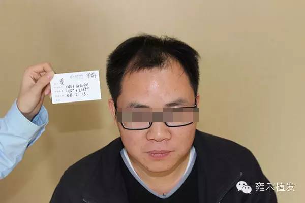 他种植3250单位轻率植发的后果是