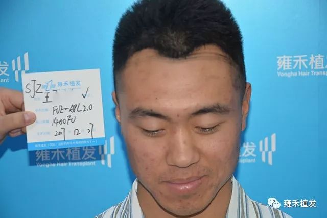 大脑门还想梳大背头难啊植发1950单位才是帅气背头！