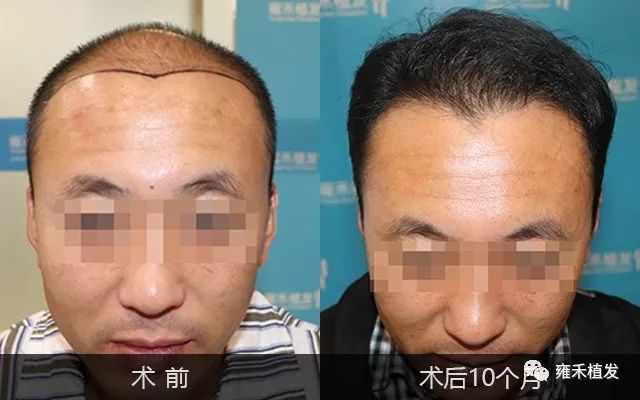 没钱贷款植发3123单位大秃顶找不到女友