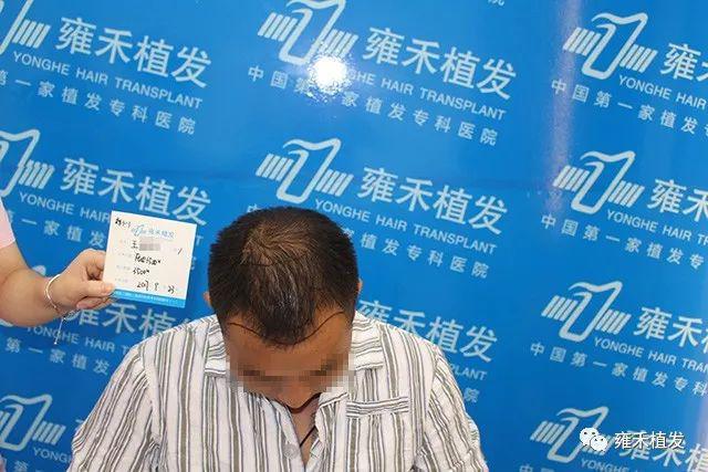 退伍兵背着医院暗里调查植发效果发现