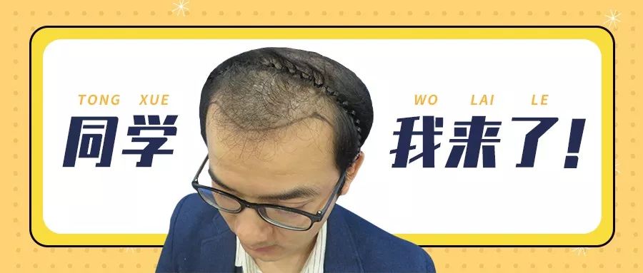 发友遗传性脱发植发4000单位能有多大改变？