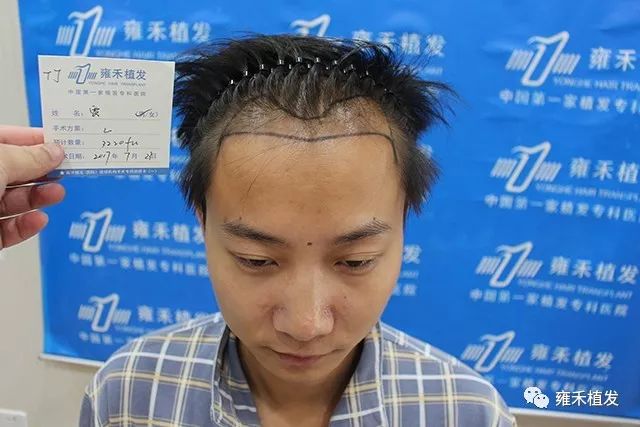 地产销售脱发严重植发3235单位1年形象上了天