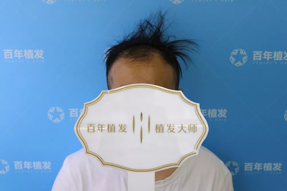 胡先生百年植发FUE种植3000毛囊亮出应有帅气自信
