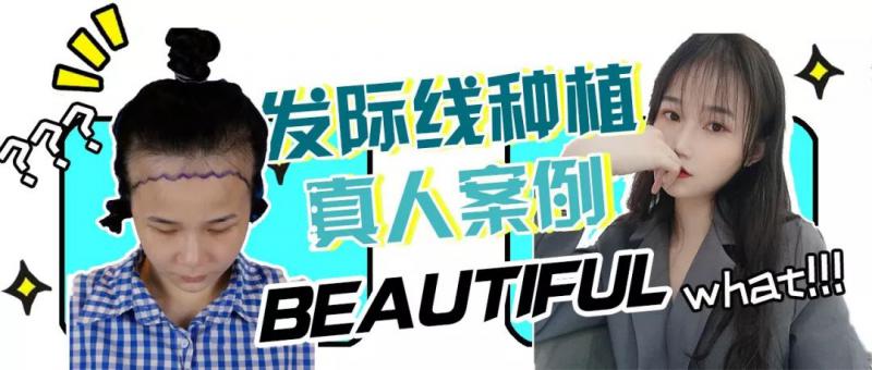 植发真人体验少女的发际线拯救计划