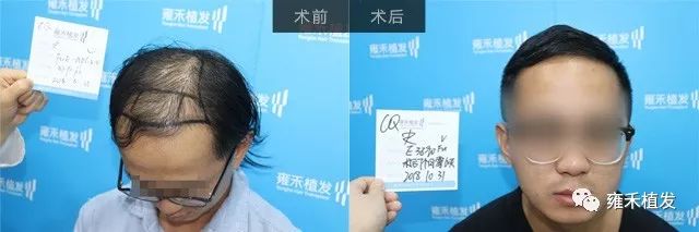 重庆雍禾植发采用FUE为史先生植发3950单位