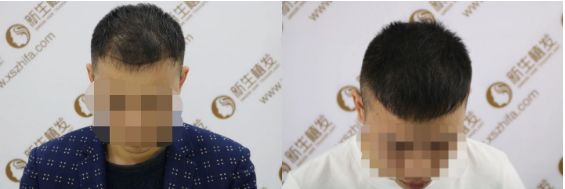 害怕植发被坑？他五个月就年轻了十岁
