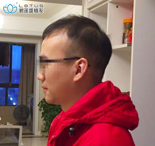 五级脱发植发后9个月竟然成这样？