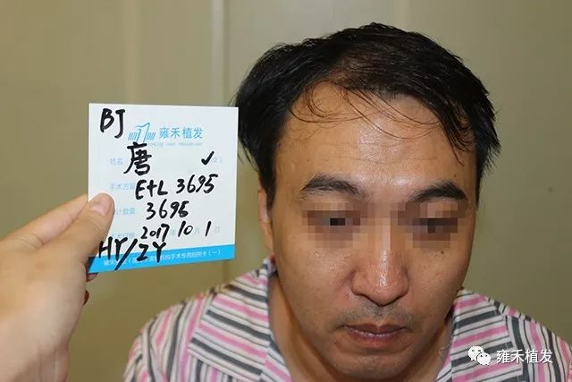 北京雍禾发友唐先生植发4171单位7个月效果