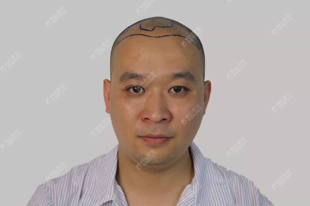 脱发后颜值暴跌植发后还会不会再脱？